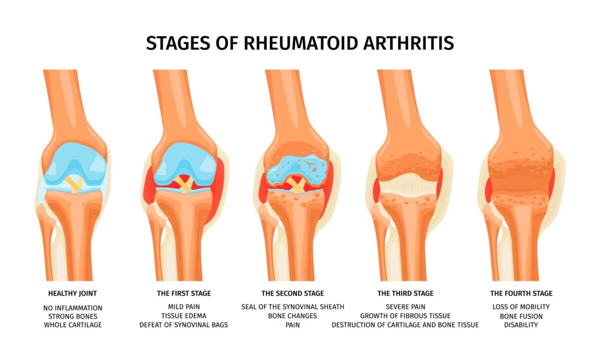 Reumatoïde artritis (RA) uitgelegd